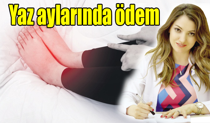 Yaz aylarında ödem