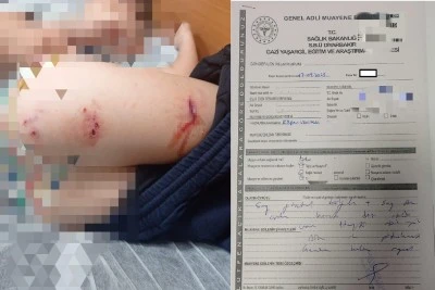 Diyarbakır'da Sokak Köpekleri 9 Yaşındaki Çocuk Yaralandı