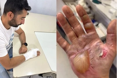 Telefon patladı tamirci yaralandı