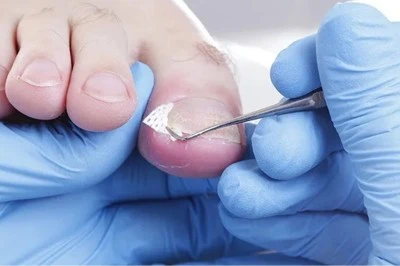 Tırnak mantarını önlemek için yapılması gerekenler